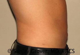 Liposuction Before and After 34 | Sanjay Grover MD FACS