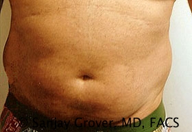 Liposuction Before and After | Sanjay Grover MD FACS