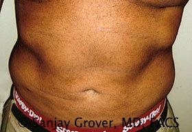 Liposuction Before and After | Sanjay Grover MD FACS