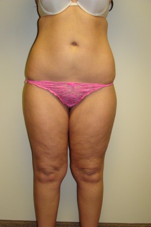 Liposuction Before and After | Grover Aesthetics