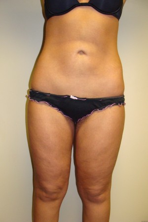 Liposuction Before and After | Grover Aesthetics