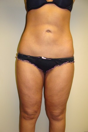 Liposuction Before and After | Sanjay Grover MD FACS