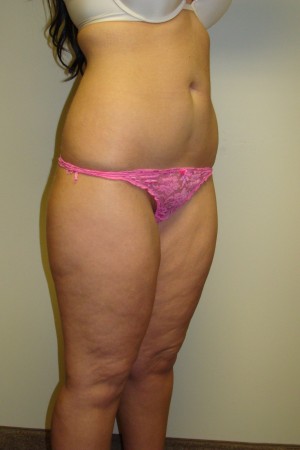 Liposuction Before and After 36 | Grover Aesthetics