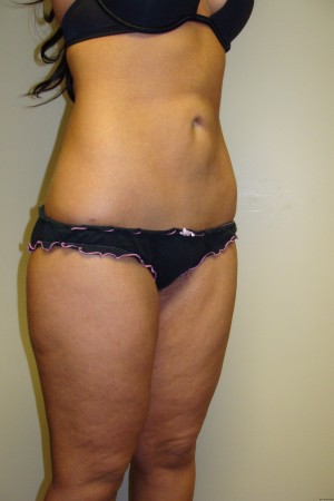 Liposuction Before and After 36 | Grover Aesthetics