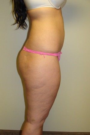 Liposuction Before and After 36 | Grover Aesthetics