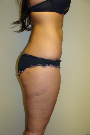 Liposuction Before and After 36 | Grover Aesthetics
