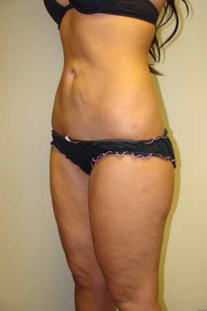 Liposuction Before and After 36 | Grover Aesthetics