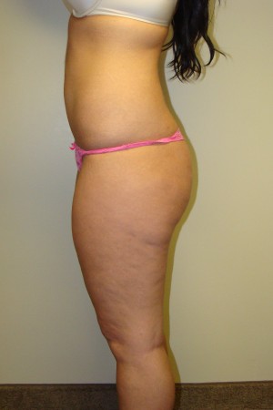 Liposuction Before and After 36 | Grover Aesthetics