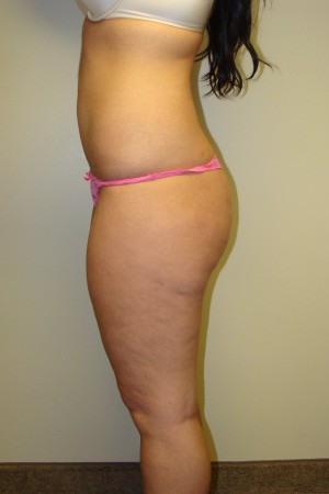 Liposuction Before and After 36 | Sanjay Grover MD FACS