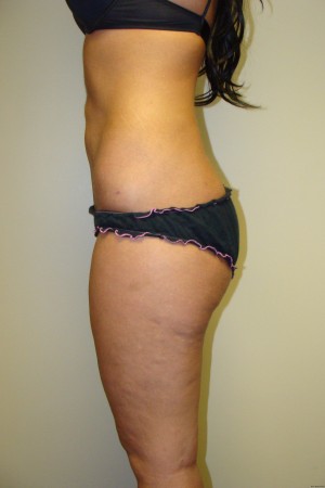 Liposuction Before and After 36 | Grover Aesthetics