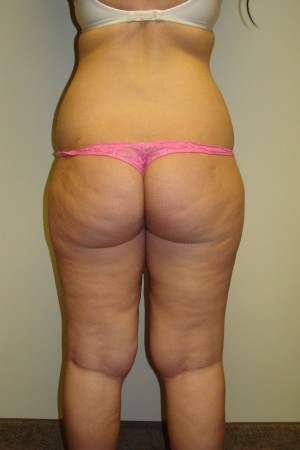 Liposuction Before and After 36 | Grover Aesthetics