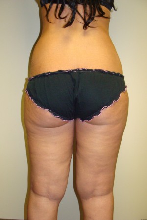 Liposuction Before and After 36 | Grover Aesthetics