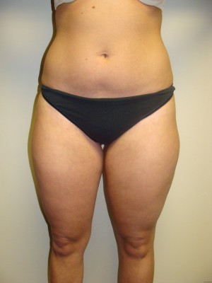 Liposuction Before and After | Grover Aesthetics