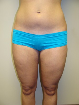 Liposuction Before and After | Grover Aesthetics