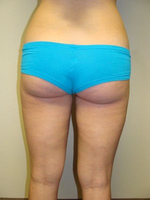Liposuction Before and After 37 | Sanjay Grover MD FACS