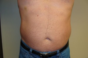 Liposuction Before and After 11 | Sanjay Grover MD FACS
