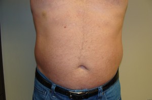 Liposuction Before and After | Grover Aesthetics