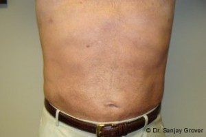 Liposuction Before and After | Sanjay Grover MD FACS