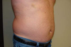Liposuction Before and After 38 | Grover Aesthetics