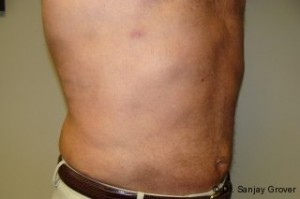 Liposuction Before and After 38 | Grover Aesthetics