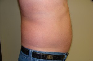 Liposuction Before and After 38 | Grover Aesthetics
