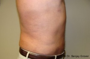 Liposuction Before and After 38 | Grover Aesthetics