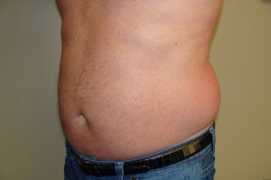 Liposuction Before and After 38 | Sanjay Grover MD FACS