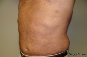 Liposuction Before and After 38 | Grover Aesthetics