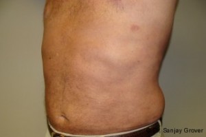 Liposuction Before and After 38 | Sanjay Grover MD FACS