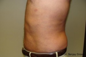 Liposuction Before and After 38 | Grover Aesthetics