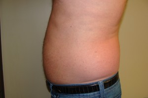 Liposuction Before and After 38 | Sanjay Grover MD FACS