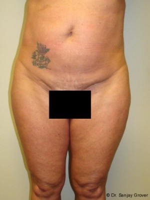 Liposuction Before and After 23 | Sanjay Grover MD FACS