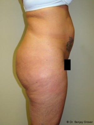 Liposuction Before and After 39 | Grover Aesthetics