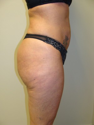 Liposuction Before and After 39 | Grover Aesthetics