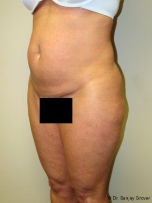 Liposuction Before and After 39 | Sanjay Grover MD FACS