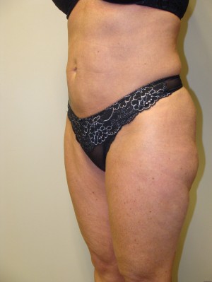 Liposuction Before and After 39 | Grover Aesthetics