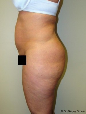 Liposuction Before and After 39 | Sanjay Grover MD FACS