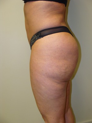Liposuction Before and After 39 | Grover Aesthetics