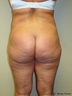 Liposuction Before and After 39 | Grover Aesthetics