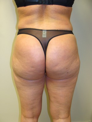 Liposuction Before and After 39 | Grover Aesthetics