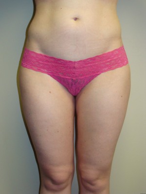 Liposuction Before and After | Grover Aesthetics