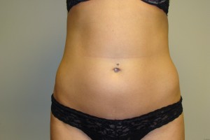 Liposuction Before and After | Grover Aesthetics