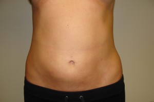 Liposuction Before and After | Grover Aesthetics