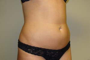 Liposuction Before and After 41 | Grover Aesthetics