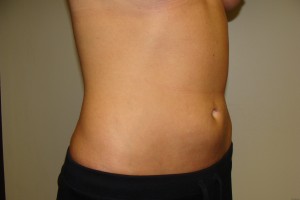 Liposuction Before and After 41 | Grover Aesthetics