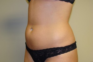 Liposuction Before and After 41 | Grover Aesthetics