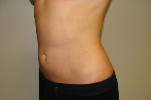 Liposuction Before and After 41 | Grover Aesthetics
