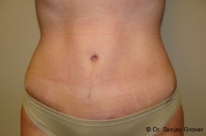 Liposuction Before and After | Grover Aesthetics