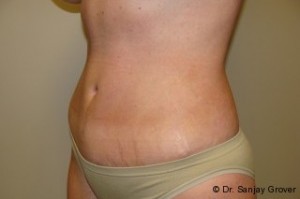 Liposuction Before and After 42 | Sanjay Grover MD FACS