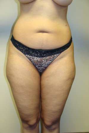 Liposuction Before and After | Grover Aesthetics
